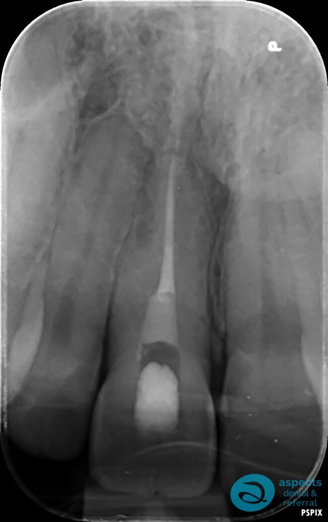 After Root Canal Treatment - Root Canal Treatment Milton Keynes - Aspects Dental Case Study 16