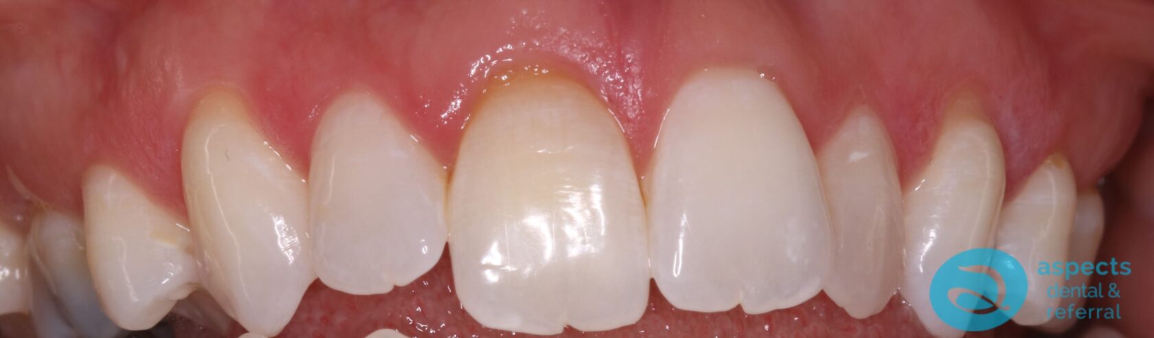 After Teeth Whitening Photo - Teeth Whitening Milton Keynes - Aspects Dental Case Study 16