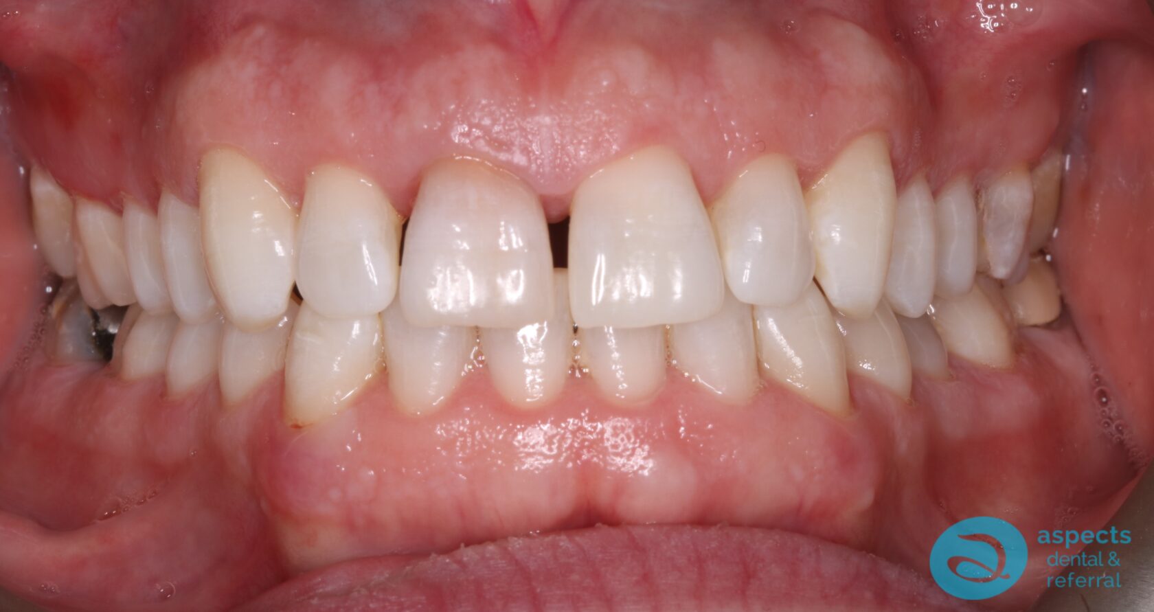 After Teeth Whitening Photo - Teeth Whitening Milton Keynes - Aspects Dental Case Study 17