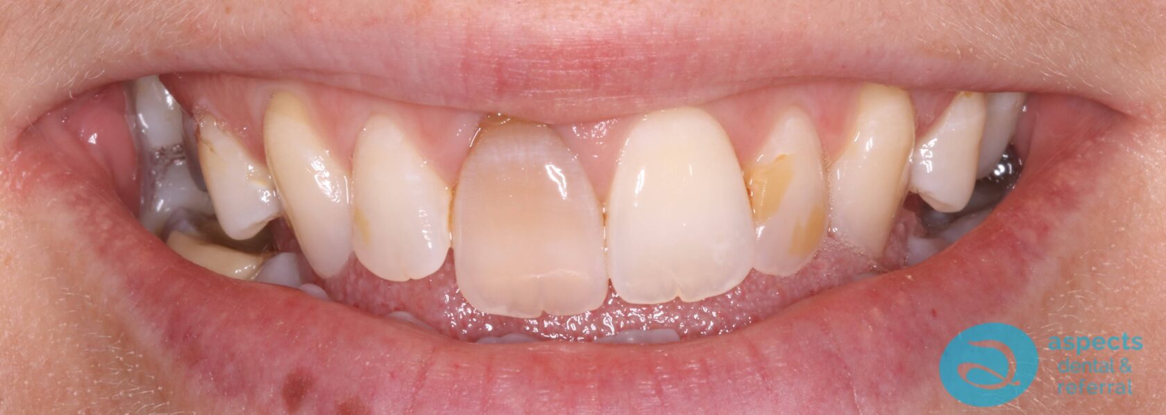 Before Teeth Whitening Photo - Teeth Whitening Milton Keynes - Aspects Dental Case Study 16