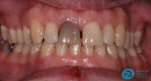 Before Teeth Whitening Photo - Teeth Whitening Milton Keynes - Aspects Dental Case Study 17