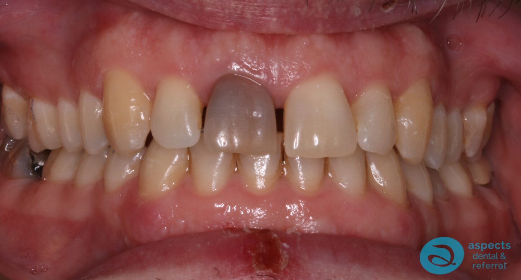 Before Teeth Whitening Photo - Teeth Whitening Milton Keynes - Aspects Dental Case Study 17