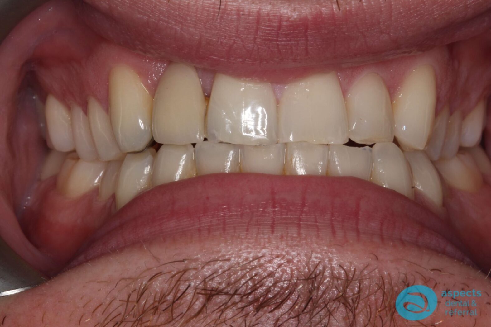 After Invisalign Treatment Photo 1 - Invisalign Milton Keynes - Aspects Dental Case Study 1