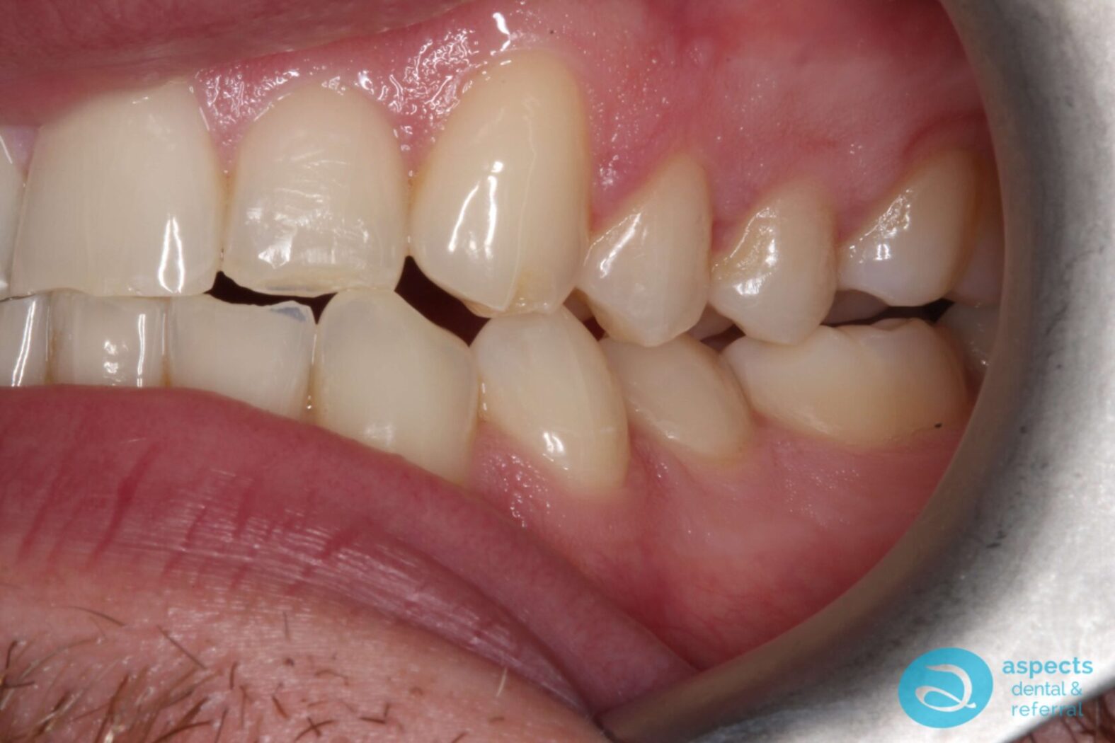 After Invisalign Treatment Photo 2 - Invisalign Milton Keynes - Aspects Dental Case Study 1