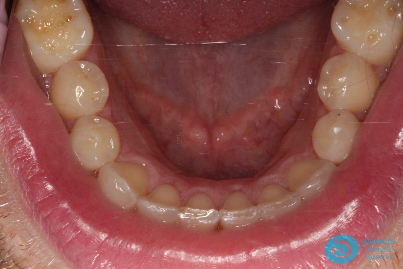 After Invisalign Treatment Photo 3 - Invisalign Milton Keynes - Aspects Dental Case Study 1