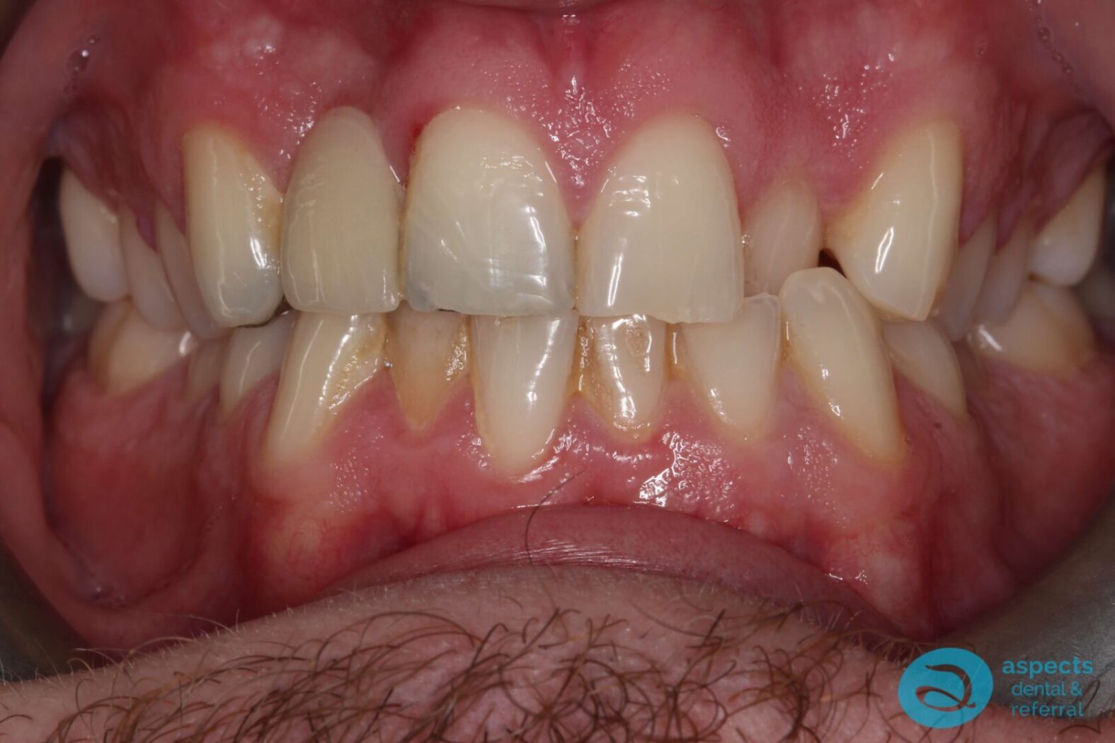 Before Invisalign Treatment Photo 1 - Invisalign Milton Keynes - Aspects Dental Case Study 1