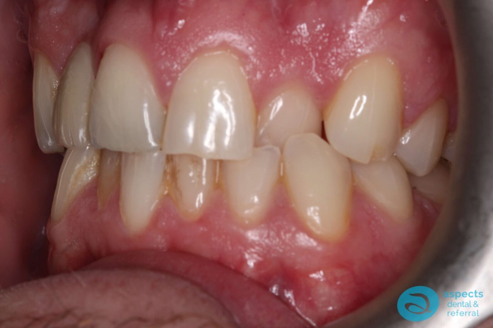 Before Invisalign Treatment Photo 2 - Invisalign Milton Keynes - Aspects Dental Case Study 1