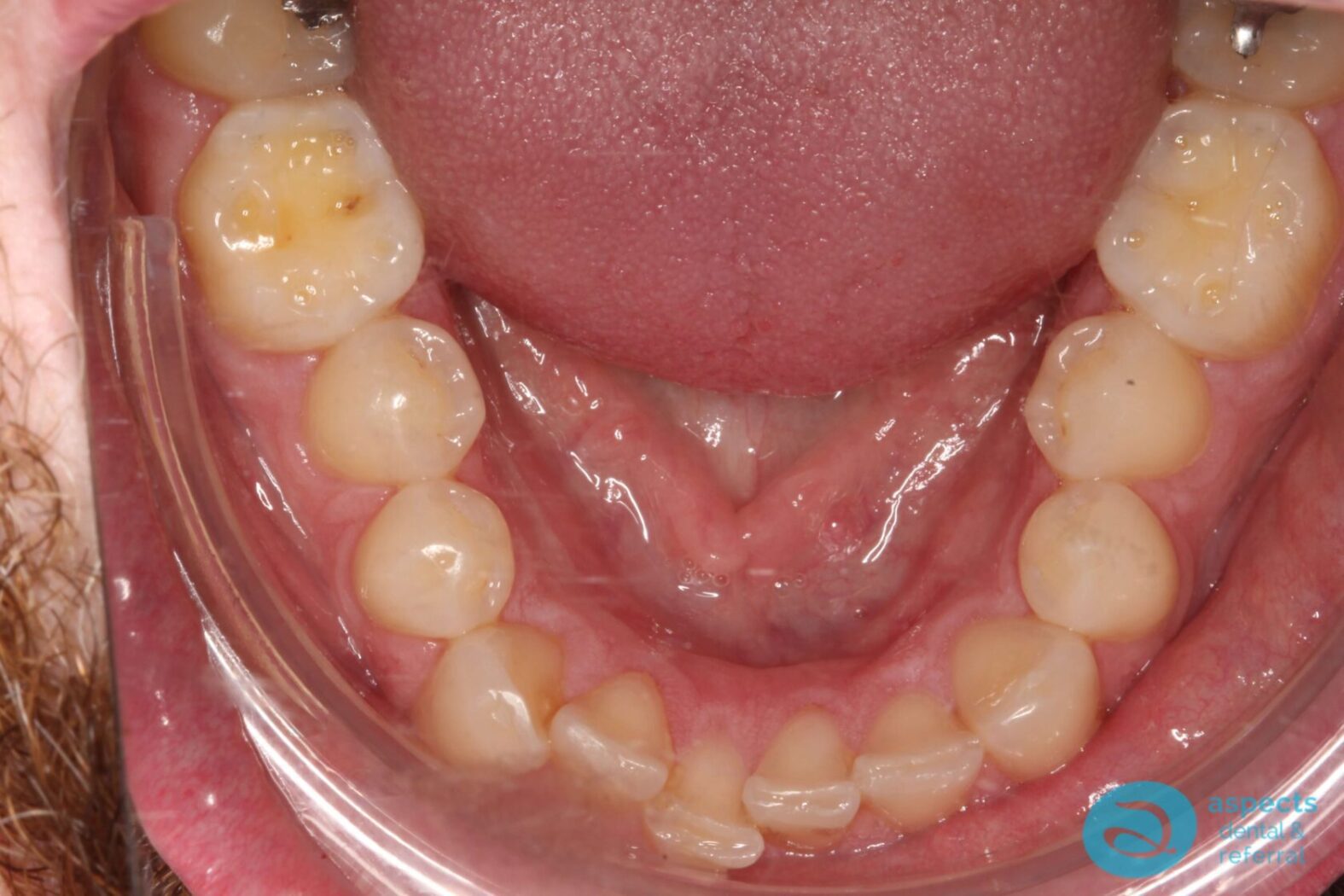 Before Invisalign Treatment Photo 3 - Invisalign Milton Keynes - Aspects Dental Case Study 1