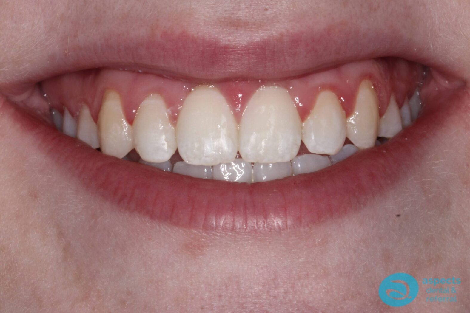 After Metal Dental Braces Photo 1 - Dental Braces Milton Keynes - Aspects Dental Case Study 9