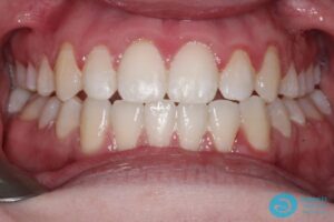 After Metal Dental Braces Photo 2 - Dental Braces Milton Keynes - Aspects Dental Case Study 9