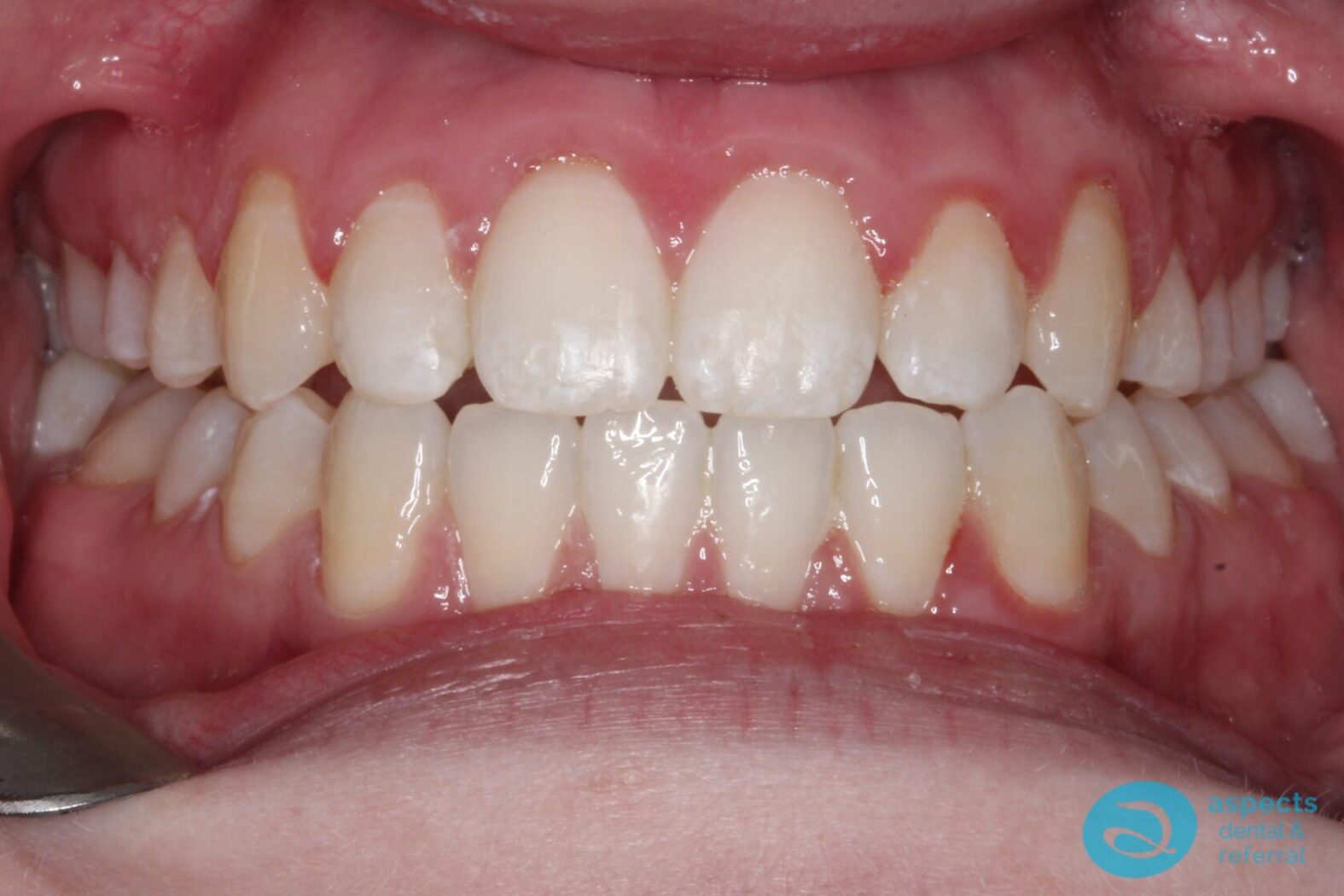 After Metal Dental Braces Photo 2 - Dental Braces Milton Keynes - Aspects Dental Case Study 9