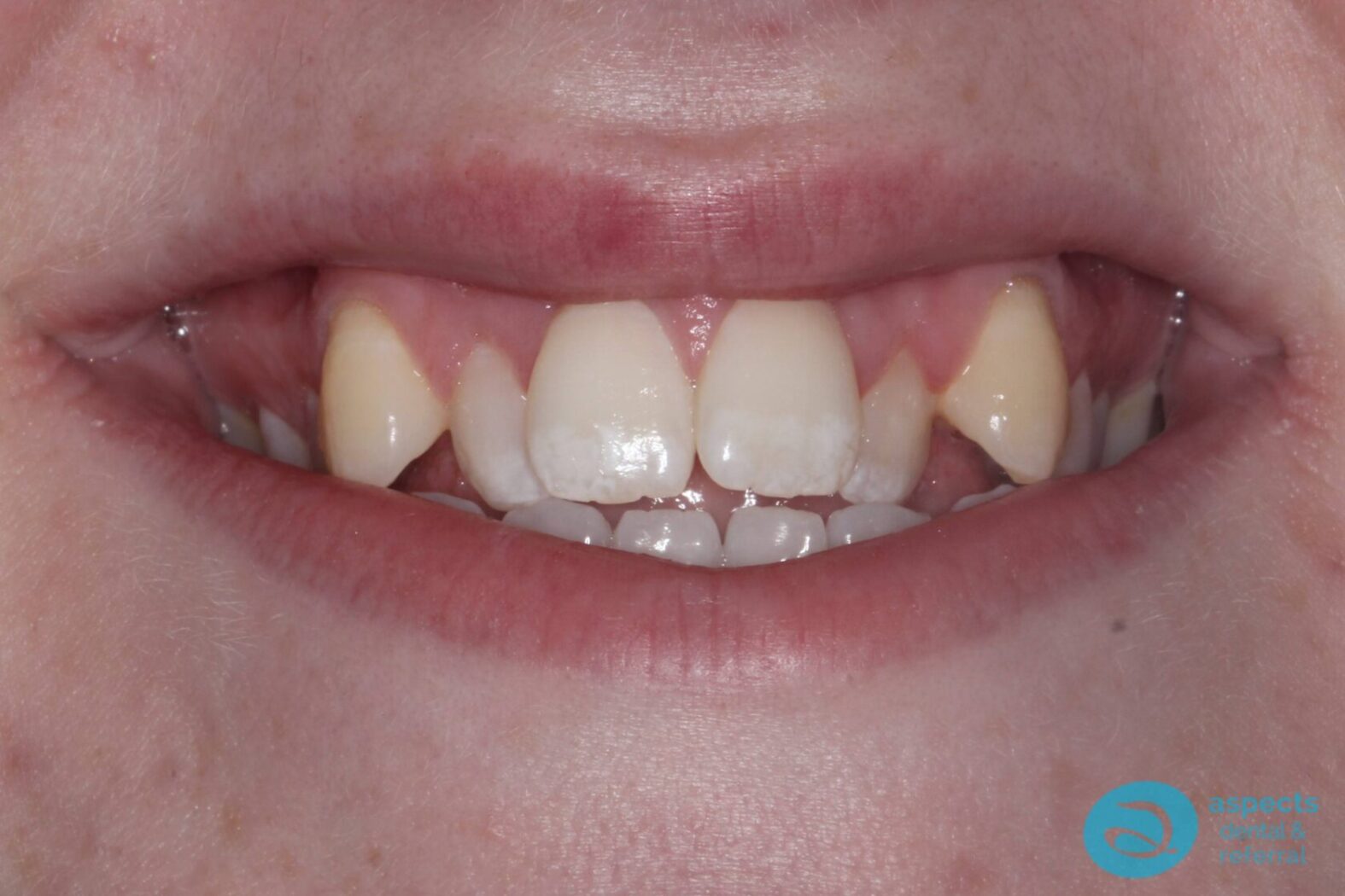 Before Metal Dental Braces Photo 1 - Dental Braces Milton Keynes - Aspects Dental Case Study 9