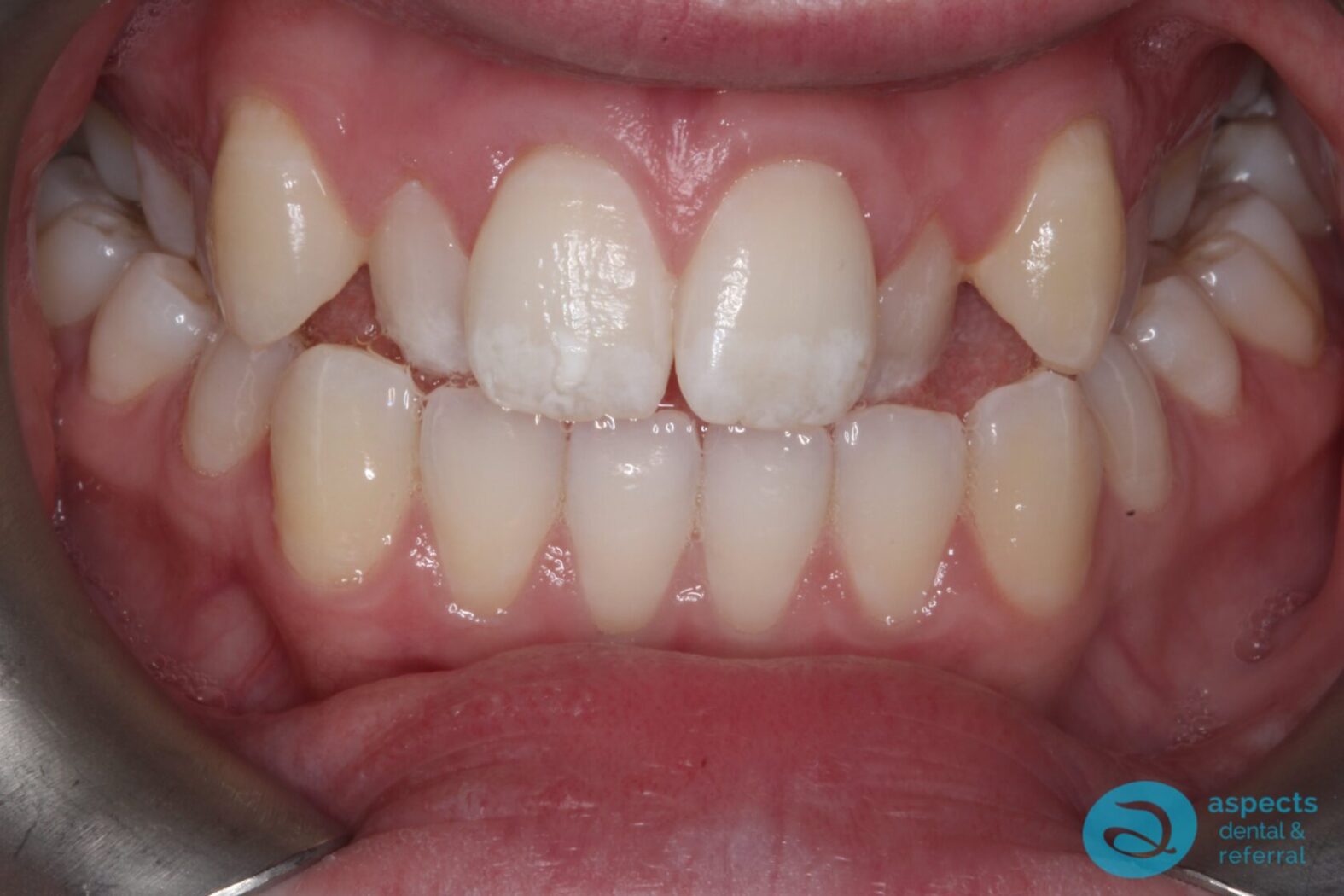 Before Metal Dental Braces Photo 2 - Dental Braces Milton Keynes - Aspects Dental Case Study 9