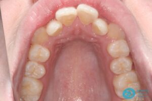 Before Metal Dental Braces Photo 3 - Dental Braces Milton Keynes - Aspects Dental Case Study 9