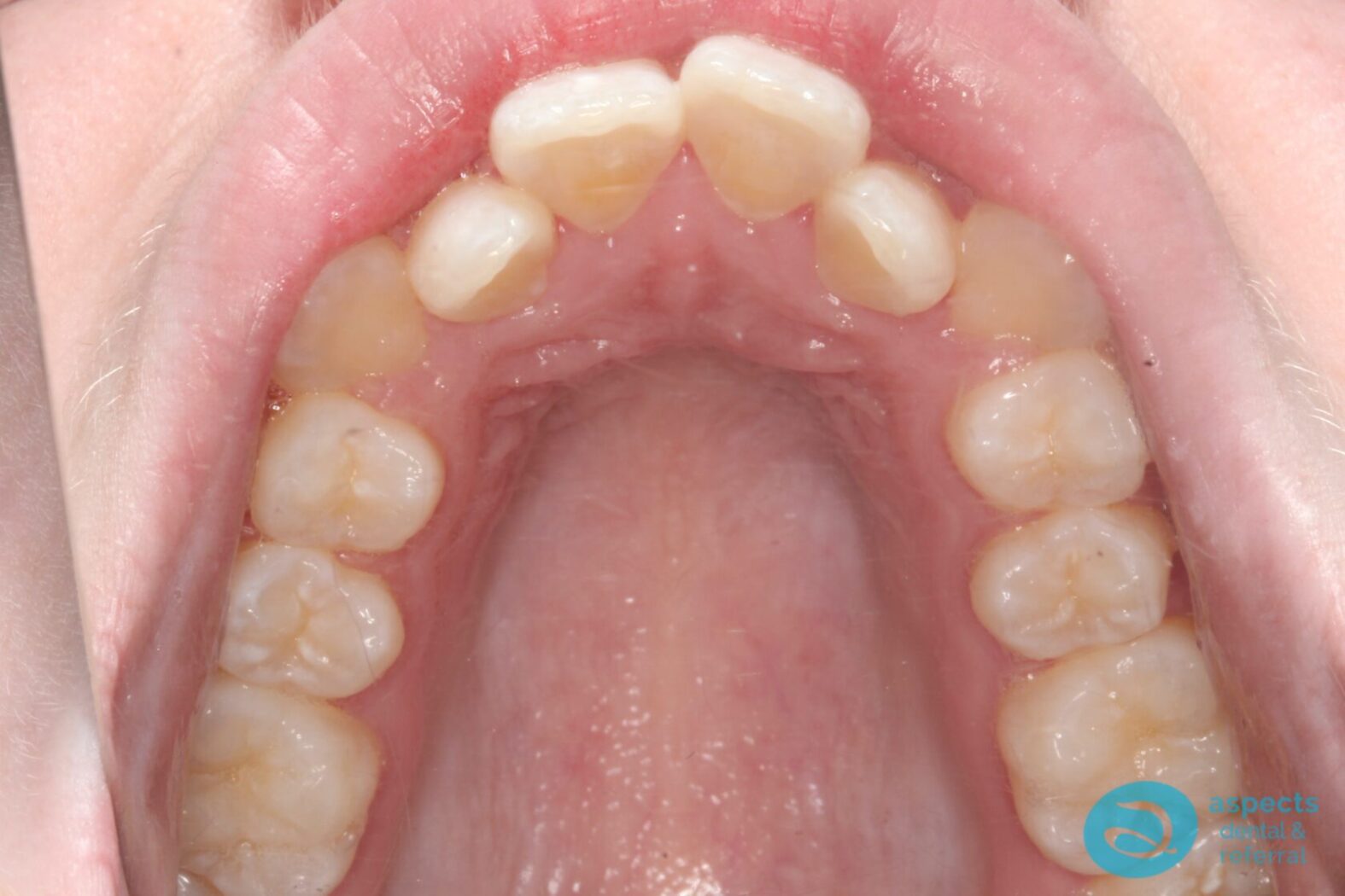 Before Metal Dental Braces Photo 3 - Dental Braces Milton Keynes - Aspects Dental Case Study 9