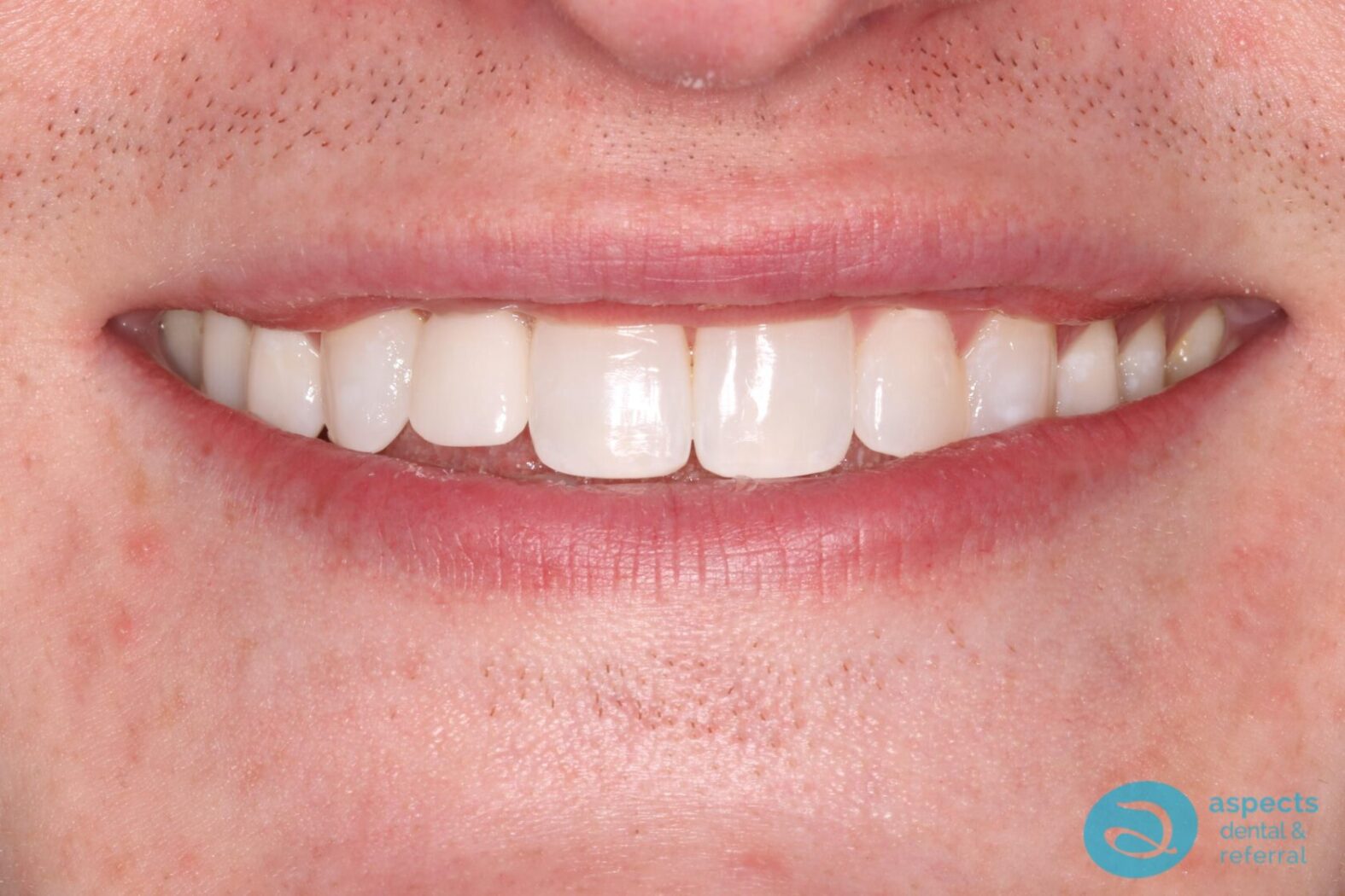 After Dental Implant Photo 1 - Dental Implants Milton Keynes - Aspects Dental Case Study 1