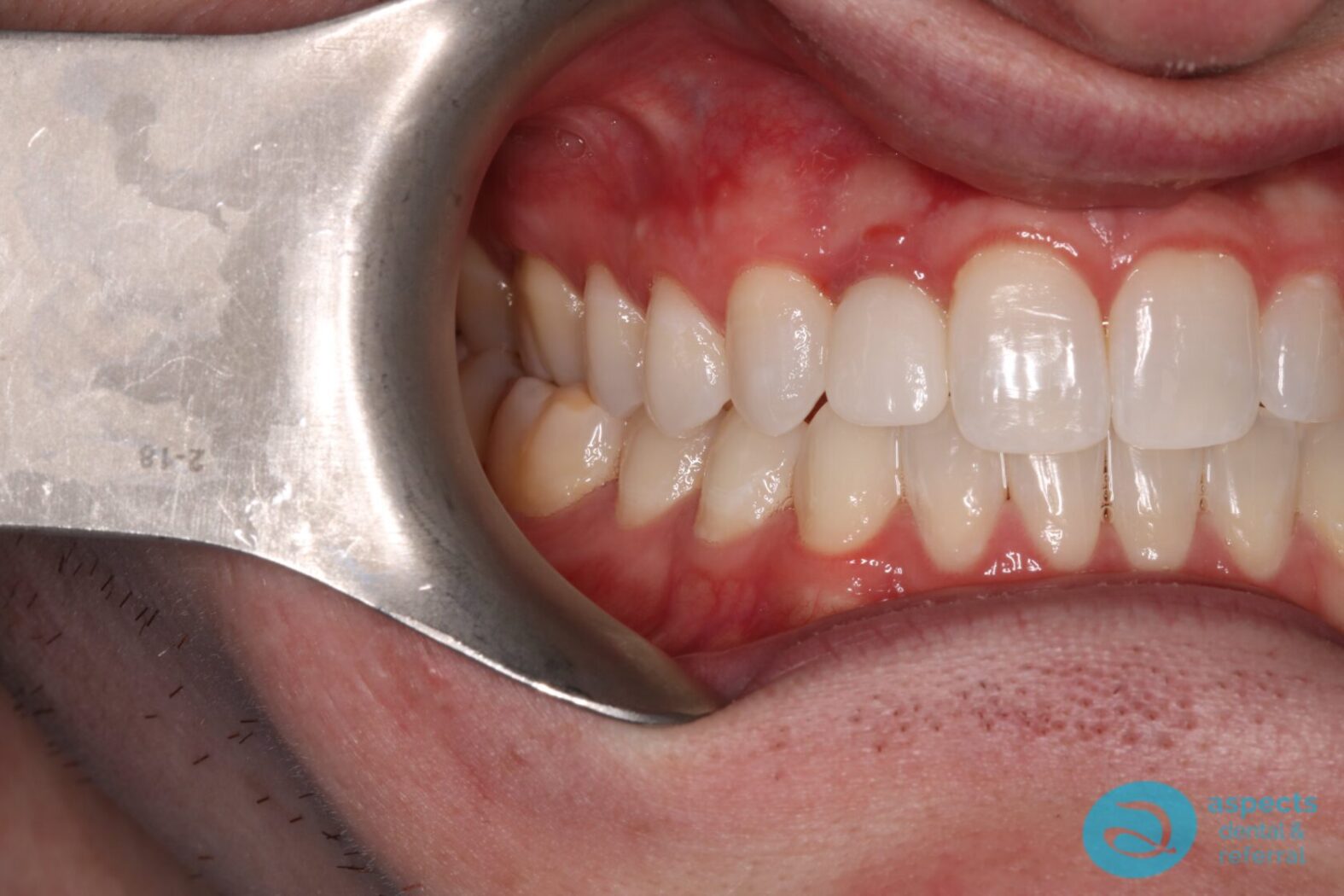 After Dental Implant Photo 2 - Dental Implants Milton Keynes - Aspects Dental Case Study 1