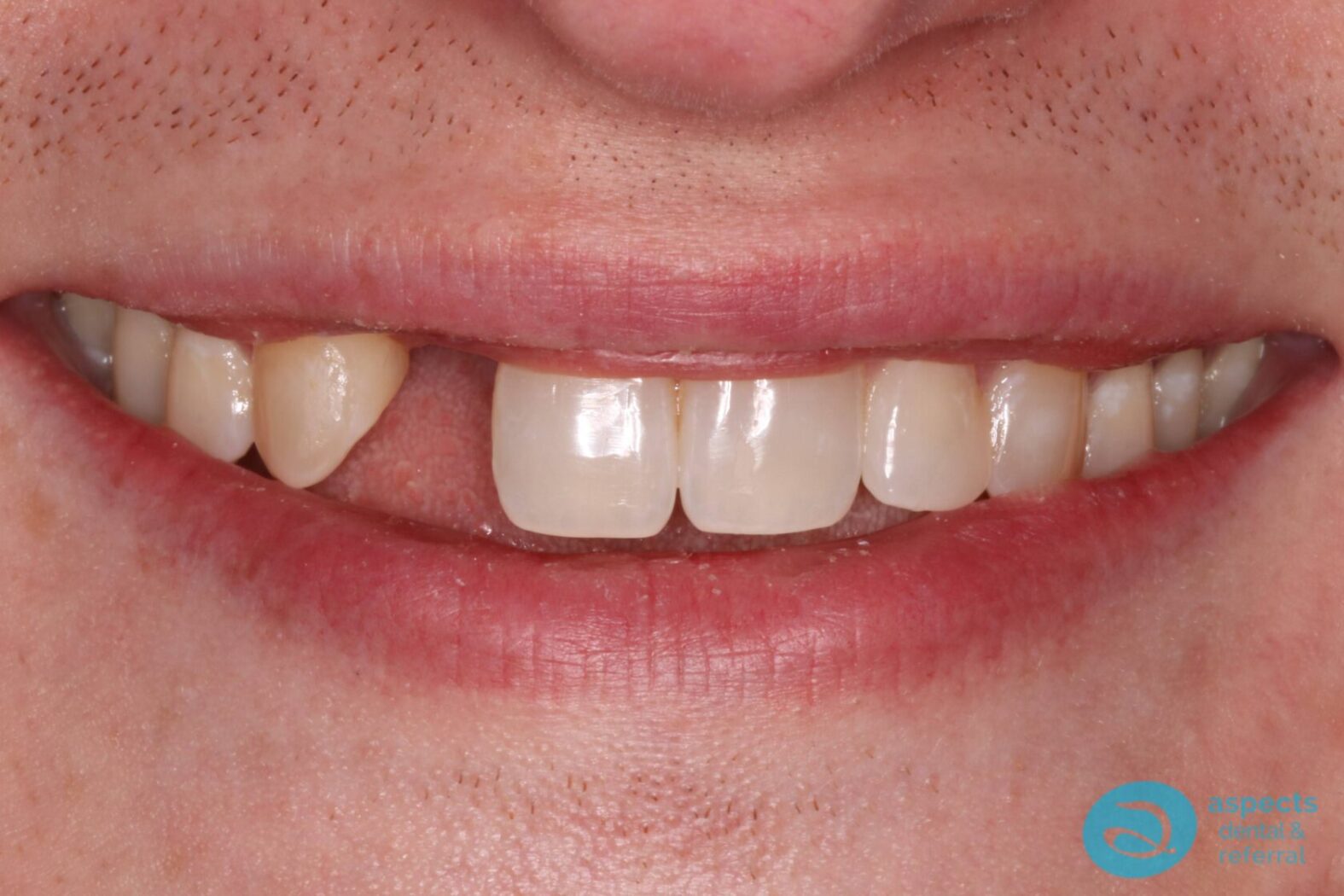 Before Dental Implant Photo 1 - Dental Implants Milton Keynes - Aspects Dental Case Study 1