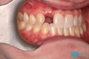 Before Dental Implant Photo 2 - Dental Implants Milton Keynes - Aspects Dental Case Study 1