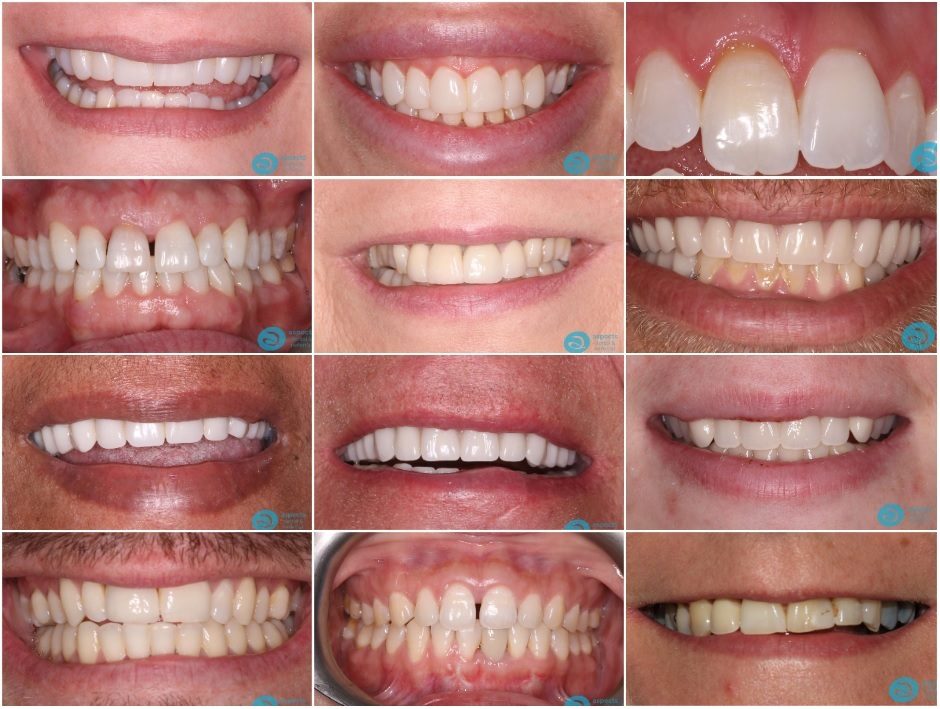 Cosmetic Dentist Before And After Gallery - Cosmetic Dentist Milton Keynes - Aspects Dental In Milton Keynes