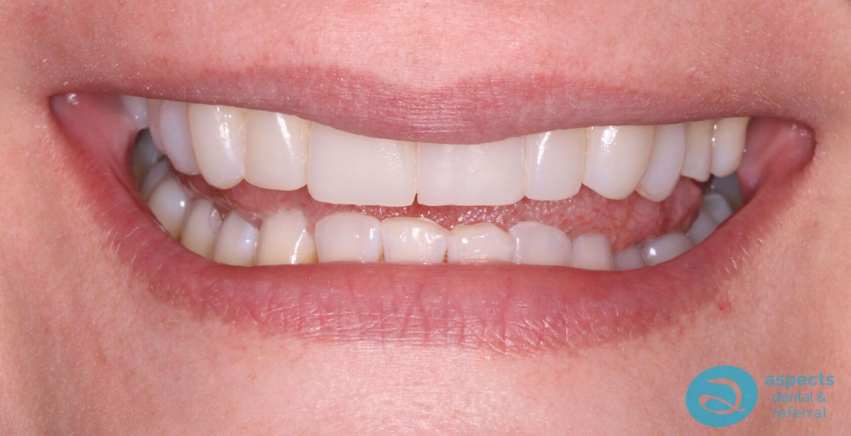 After Dental Veneers Photo 1 - Dental Veneers Milton Keynes - Aspects Dental Case Study 3 After Dental Veneers Photo 1 - Dental Veneers Milton Keynes - Aspects Dental Case Study 3