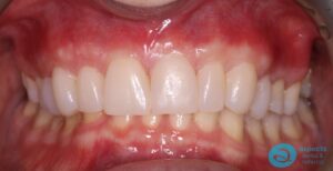 After Dental Veneers Photo 2 - Dental Veneers Milton Keynes - Aspects Dental Case Study 3