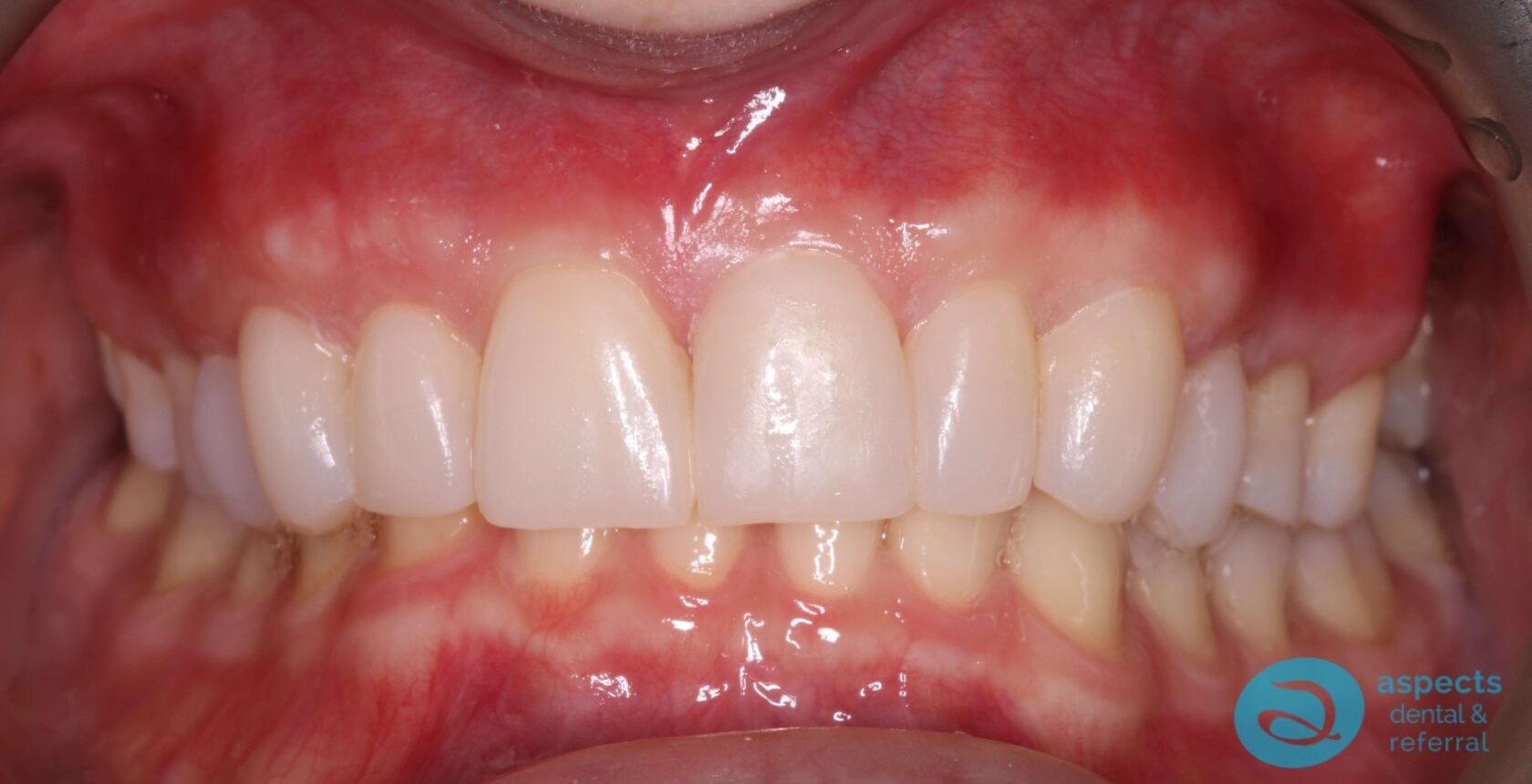 After Dental Veneers Photo 2 - Dental Veneers Milton Keynes - Aspects Dental Case Study 3 After Dental Veneers Photo 2 - Dental Veneers Milton Keynes - Aspects Dental Case Study 3