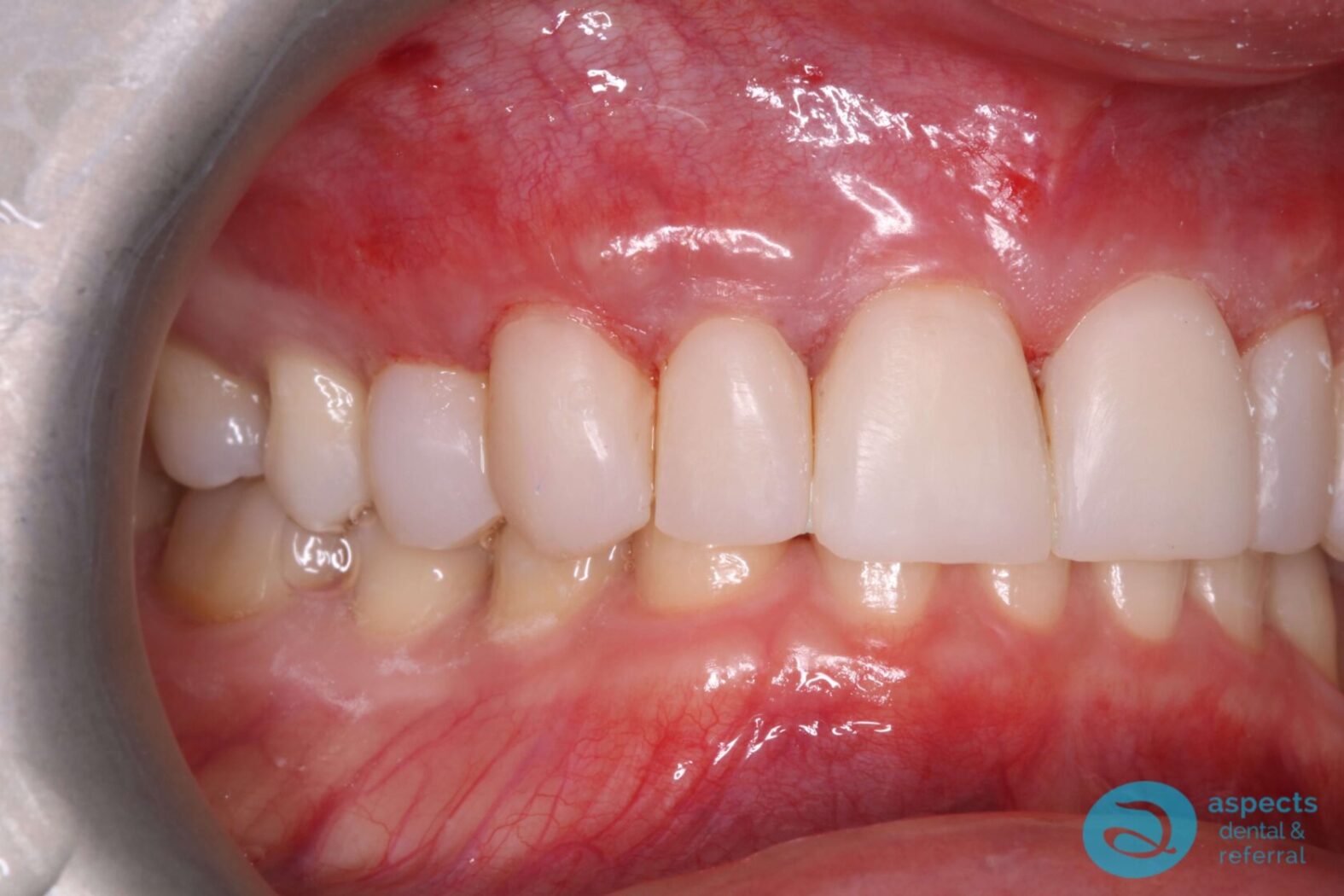 After Dental Veneers Photo 3 - Dental Veneers Milton Keynes - Aspects Dental Case Study 3 After Dental Veneers Photo 3 - Dental Veneers Milton Keynes - Aspects Dental Case Study 3