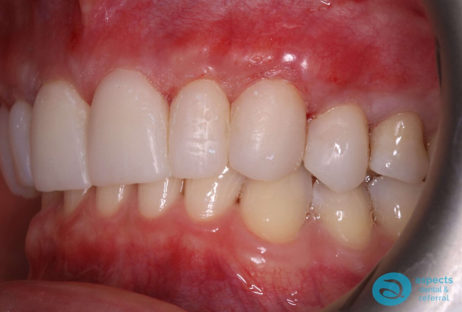 After Dental Veneers Photo 4 - Dental Veneers Milton Keynes - Aspects Dental Case Study 3 After Dental Veneers Photo 4 - Dental Veneers Milton Keynes - Aspects Dental Case Study 3