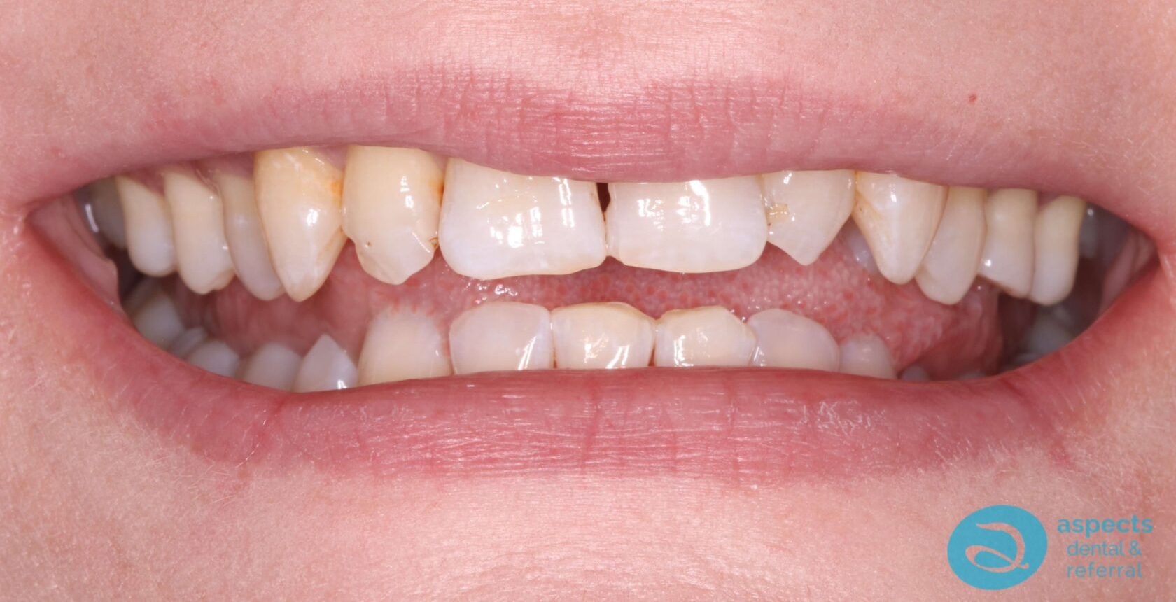 Before Dental Veneers Photo 1 - Dental Veneers Milton Keynes - Aspects Dental Case Study 3 Before Dental Veneers Photo 1 - Dental Veneers Milton Keynes - Aspects Dental Case Study 3