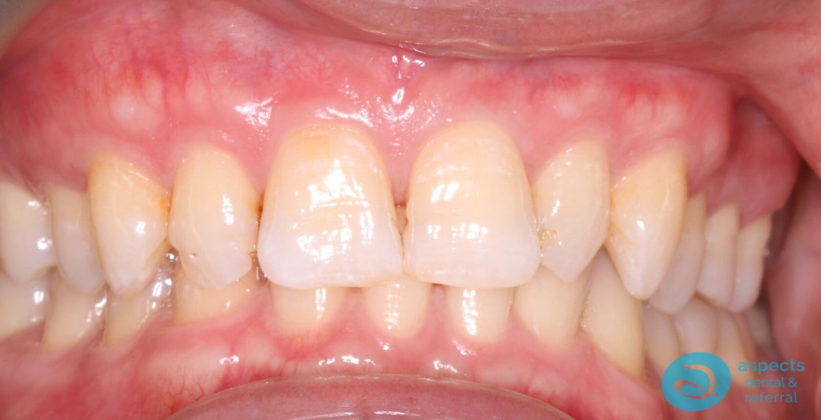 Before Dental Veneers Photo 2 - Dental Veneers Milton Keynes - Aspects Dental Case Study 3 Before Dental Veneers Photo 2 - Dental Veneers Milton Keynes - Aspects Dental Case Study 3