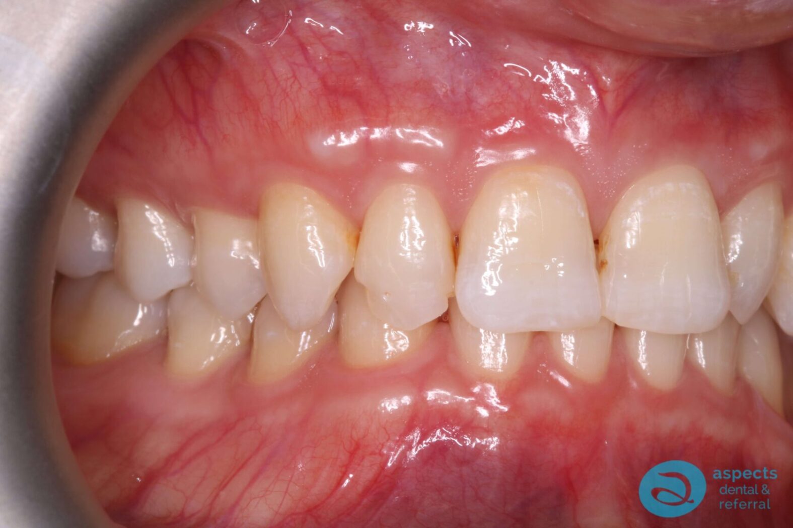 Before Dental Veneers Photo 3 - Dental Veneers Milton Keynes - Aspects Dental Case Study 3 Before Dental Veneers Photo 3 - Dental Veneers Milton Keynes - Aspects Dental Case Study 3