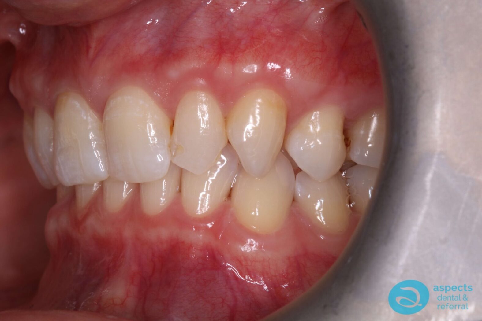 Before Dental Veneers Photo 4 - Dental Veneers Milton Keynes - Aspects Dental Case Study 3 Before Dental Veneers Photo 4 - Dental Veneers Milton Keynes - Aspects Dental Case Study 3
