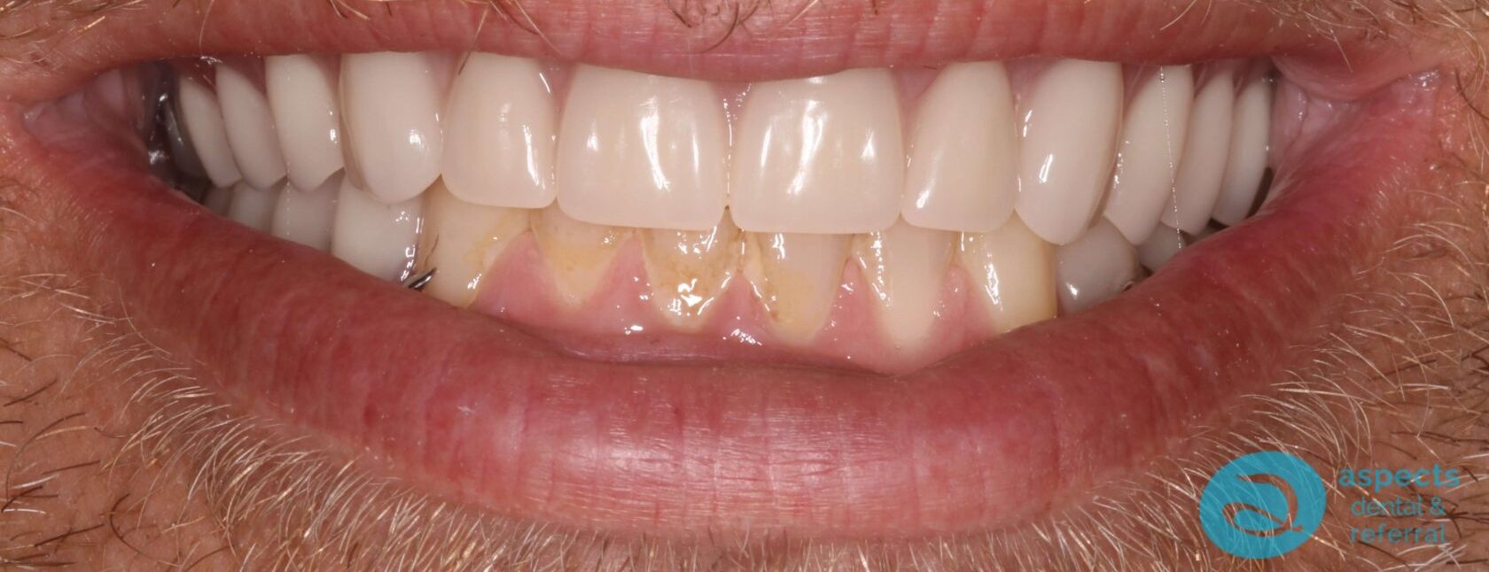 After Upper & Lower Dentures Photo 1 - Dentures Milton Keynes - Aspects Dental Case Study 35 After Upper & Lower Dentures Photo 1 - Dentures Milton Keynes - Aspects Dental Case Study 35