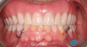 After Upper & Lower Dentures Photo 2 - Dentures Milton Keynes - Aspects Dental Case Study 35