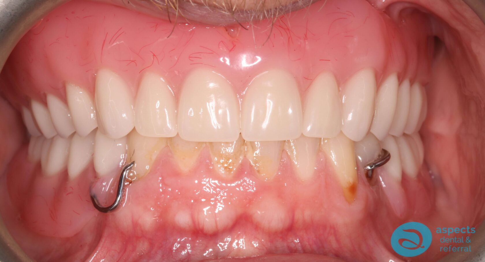 After Upper & Lower Dentures Photo 2 - Dentures Milton Keynes - Aspects Dental Case Study 35 After Upper & Lower Dentures Photo 2 - Dentures Milton Keynes - Aspects Dental Case Study 35