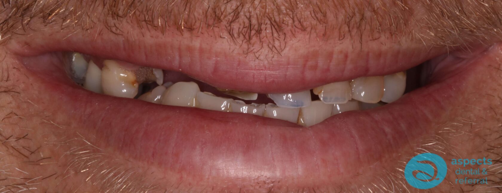 Before Upper & Lower Dentures Photo 1 - Dentures Milton Keynes - Aspects Dental Case Study 35 Before Upper & Lower Dentures Photo 1 - Dentures Milton Keynes - Aspects Dental Case Study 35