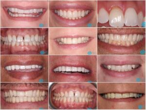 Milton Keynes Dentist Offers Cosmetic Dentistry Discounts For Summer 2025 - Before & After Cosmetic Dentistry Photos