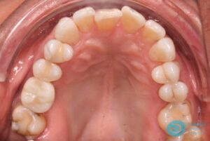 After Dental Implant Photo 1 - Dental Implants Milton Keynes - Aspects Dental Case Study 13