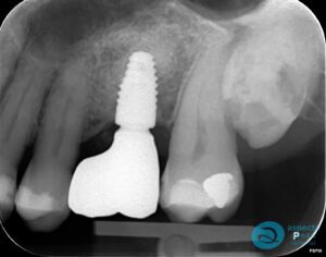 After Dental Implant Photo 3 - Dental Implants Milton Keynes - Aspects Dental Case Study 13