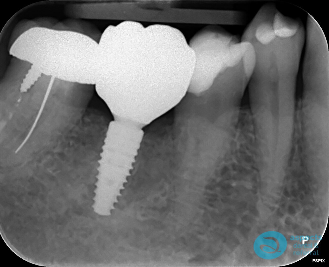 After Dental Implant Photo - Dental Implants Milton Keynes - Aspects Dental Case Study 21