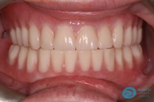 After Implant-Retained Overdentures Photo - Dental Implants Milton Keynes - Aspects Dental Case Study 19