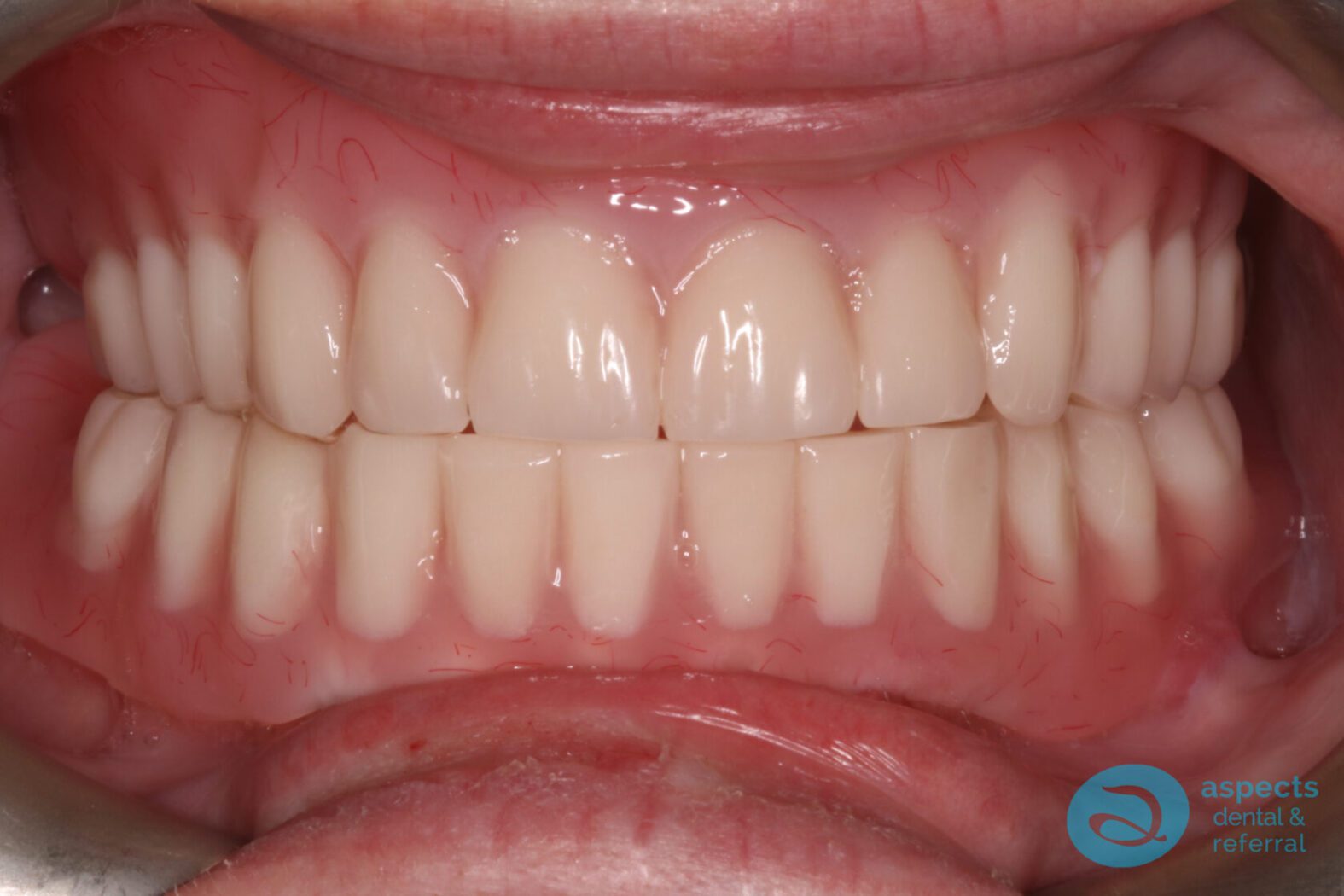 After Implant-Retained Overdentures Photo - Dental Implants Milton Keynes - Aspects Dental Case Study 19 After Implant-Retained Overdentures Photo - Dental Implants Milton Keynes - Aspects Dental Case Study 19