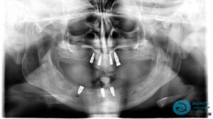 After Implant-Retained Overdentures Xray - Dental Implants Milton Keynes - Aspects Dental Case Study 19