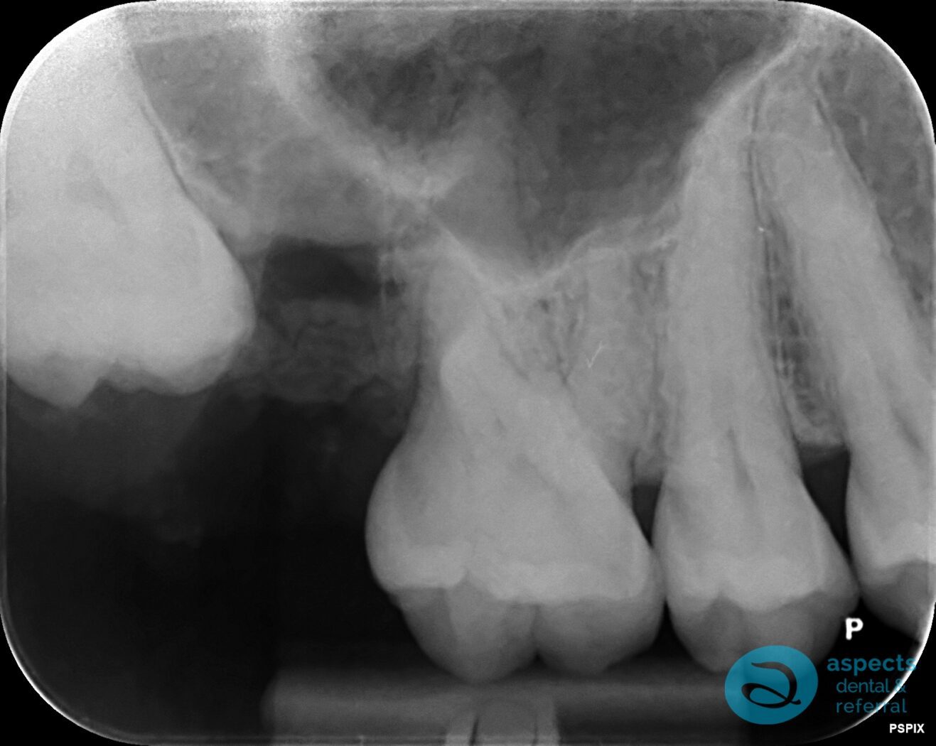 After Tooth Extraction Photo 1 - Tooth Extraction Milton Keynes - Aspects Dental Case Study 12