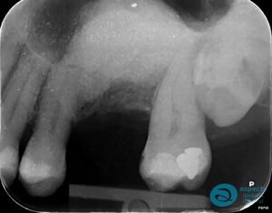 After Tooth Extraction Photo 2 - Dental Implants Milton Keynes - Aspects Dental Case Study 13