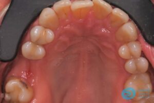 Before Dental Implant Photo 1 - Dental Implants Milton Keynes - Aspects Dental Case Study 13