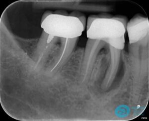 Before Extraction & Implant Photo - Dental Implants Milton Keynes - Aspects Dental Case Study 21