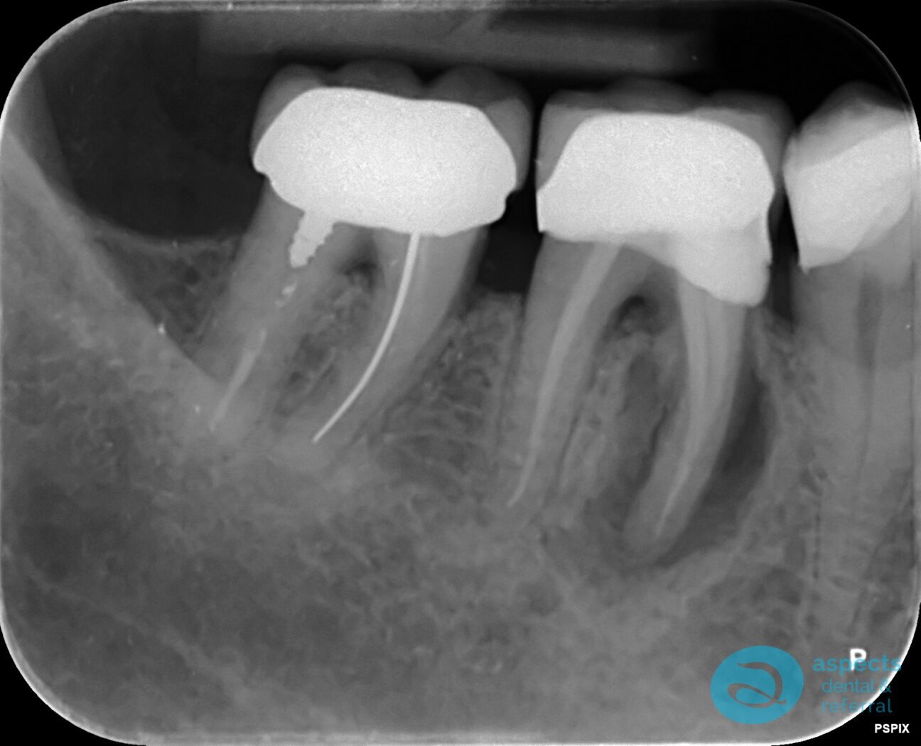 Before Extraction & Implant Photo - Dental Implants Milton Keynes - Aspects Dental Case Study 21