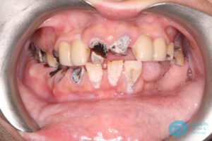 Before Implant-Retained Overdentures Photo - Dental Implants Milton Keynes - Aspects Dental Case Study 19